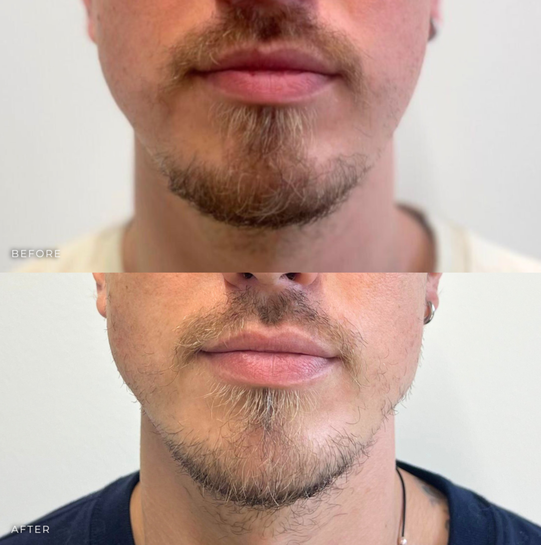 Jawline Filler 